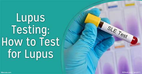 elisa test lupus|blood test for lupus infection.